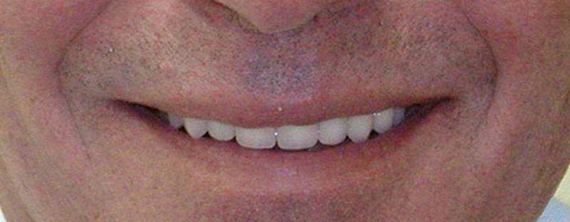 Man's smile after cosmetic dentistry