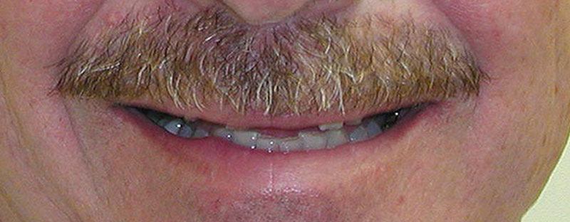 Man's smile before cosmetic dentistry