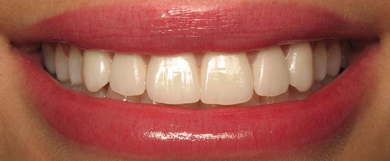 Closeup of smile after cosmetic dentistry