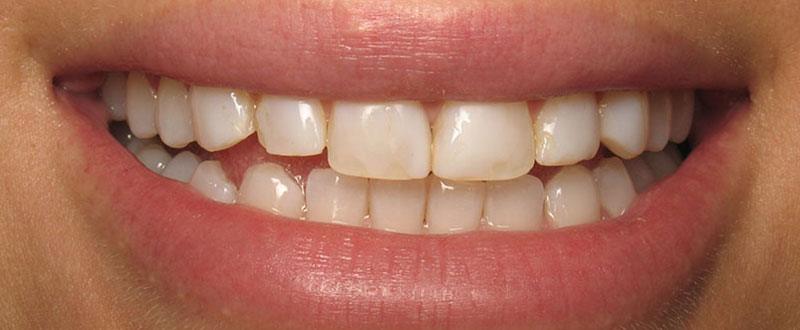 Closeup of smile before cosmetic dentistry