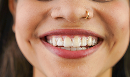 Woman smiling with a clear aligner over her teeth