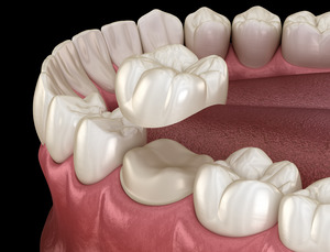 Illustration of a tooth receiving a CEREC crown