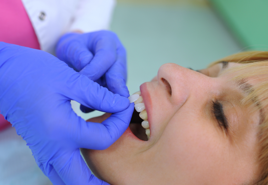 Patient getting veneers placed