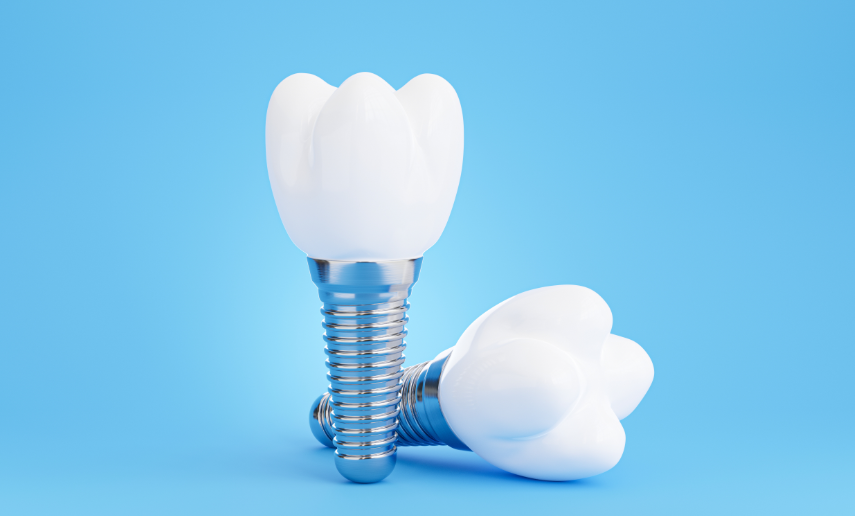 Dental implants